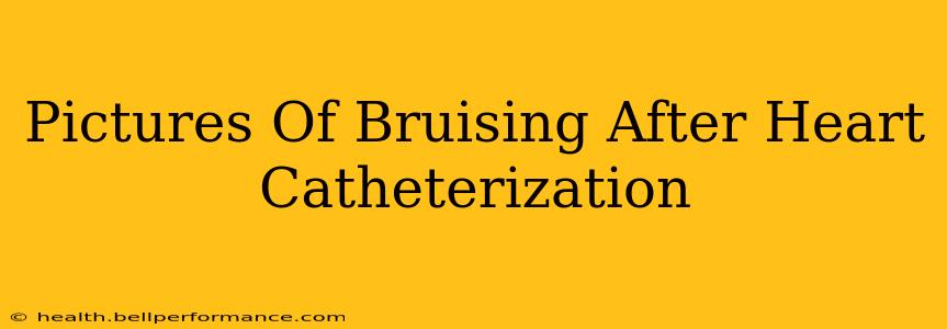 Pictures Of Bruising After Heart Catheterization